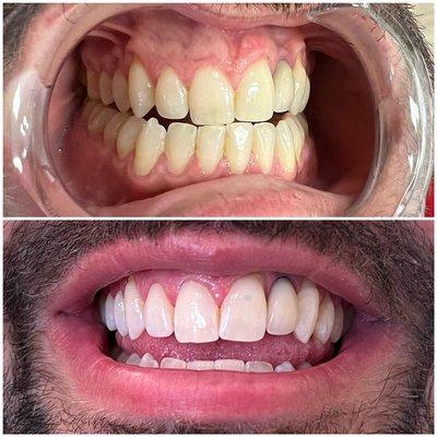 LED Teeth Whitening