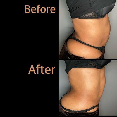 Deluxe Snatched Treatment- Slimming Treatment on Tummy area- 1 session