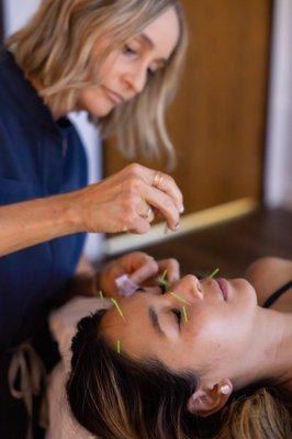 Facial Rejuvenation acupuncture with Lauren