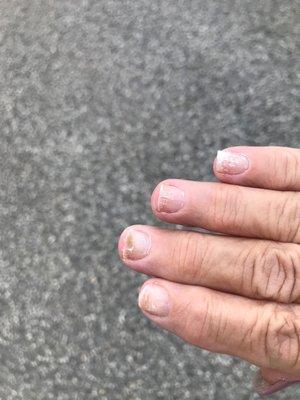 Fungus on two nails after two weeks.