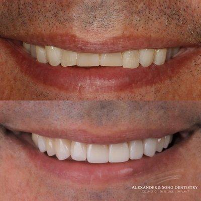 Beautiful porcelain veneers