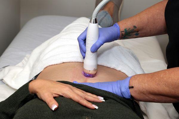 RF MIcroneedling on the abdomen