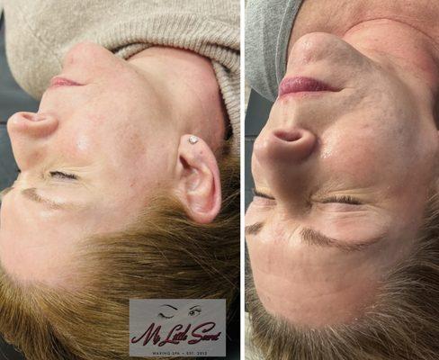 Microneedling to transform acne scars. 
Package of 3 plus rlt and combo method. 
Virtual consultations