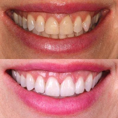 Invisalign to improve position of back teeth. Replacement of old veneers in the front.