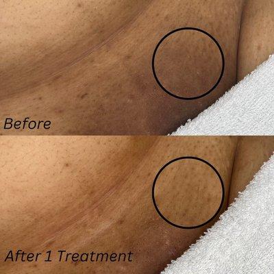 Vaginal lightening results after 1 treatment.