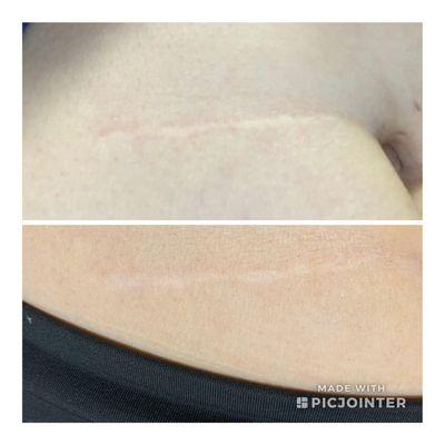 1 session scar microneedling before and after 3 weeks between top pic and bottom pic.