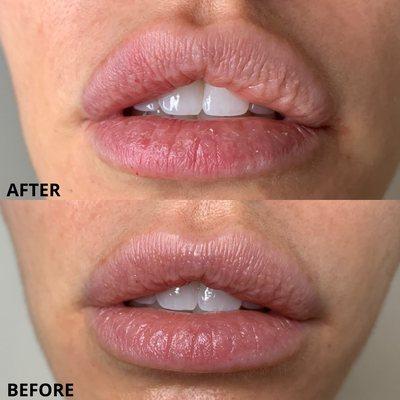 PDO Threads placed in her lip borders which helps sharpen the borders and plump the lips.