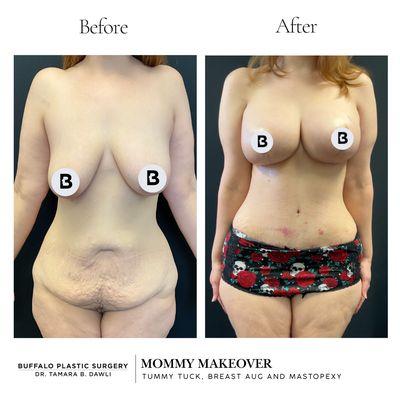 mommy makeover