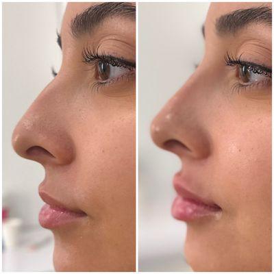 Nose correction with HA filler