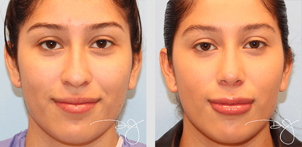 Rhinoplasty