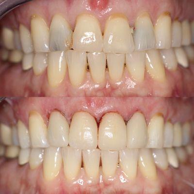 yes more veneers, beauty of in office lab, is we can provide amazing service same day.