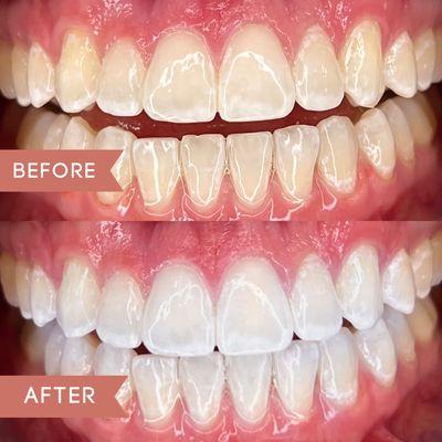 Are you wanting a whiter smile?? Let's book an appointment to get you started!