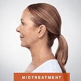 Midtreatment of Kybella