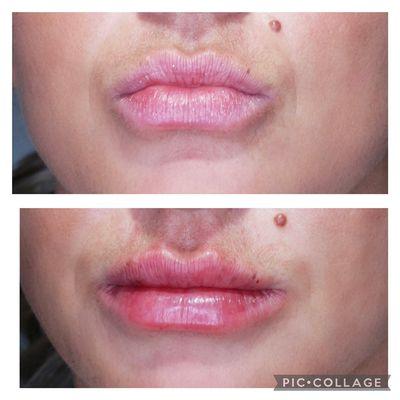 0.8ml Restylane Refyne in the lips for a natural looking lip enhancement