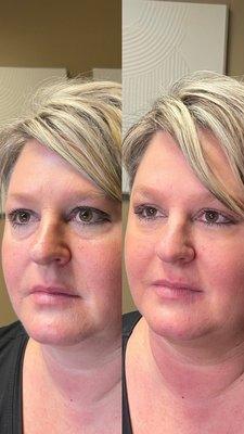 Results after treatment for volume loss in the tear trough area.