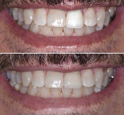 Replacement of a single anterior crown to better match the rest of the smile. Case designed and completed by Dr. Tatevik Pilosyan.