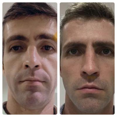 Hyperdilute Radiesse before and after 2 treatments.