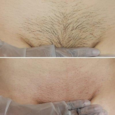 Brazilian Wax