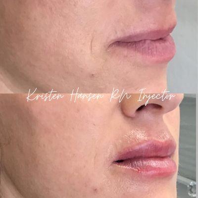 Dermal filler