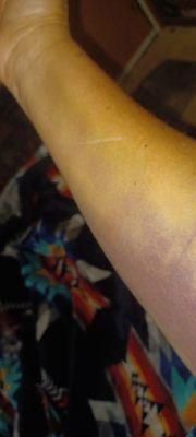 Arm hematoma.