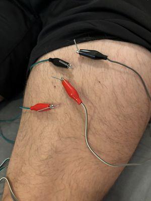 Dry Needling - Effective treatment for subacute sprain/strain's.