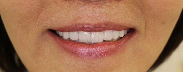 Porcelain Veneers layered for a natural smile