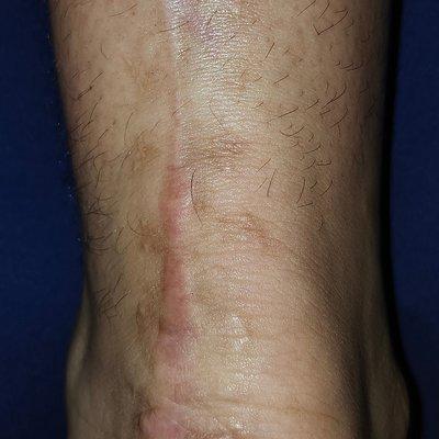 Treatment for post Achilles heal surgery