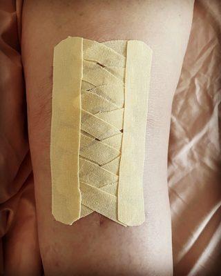 Scar taping after total knee replacement.