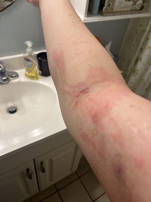 Arm burns and bruises three days out