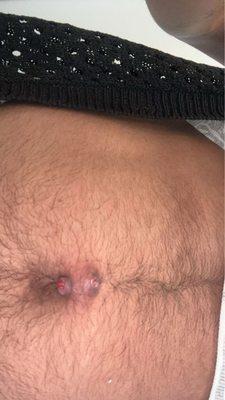 Infected belly piercing