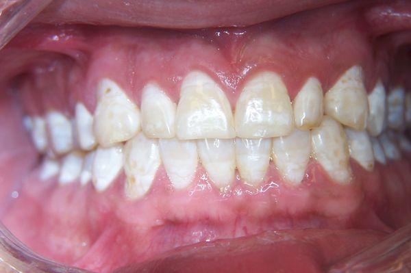 Before discolored enamel and dentin