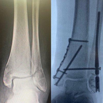 Ankle Fracture