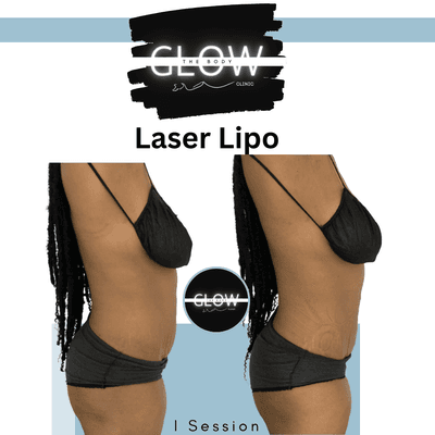 1 Session of wood therapy with Laser Lipo