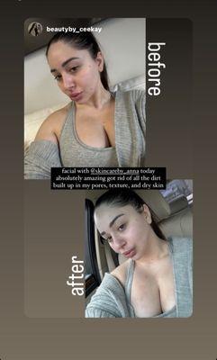 Before and After Facial with extraction!!!