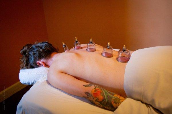 Suction cup cupping