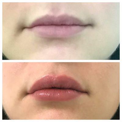 Restylane Defyne in lips