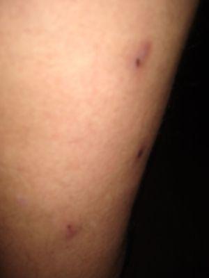 Unknown bed bites after one night.