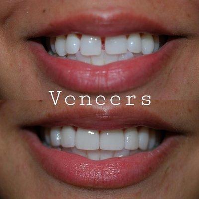 Veneers