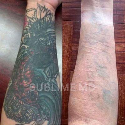 Laser Tattoo Removal