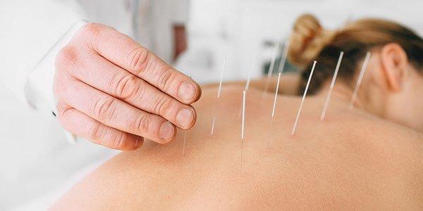 Have you heard of Dry needling and the amazing results patients are getting with their pain? Call 727-596-2101 more information!