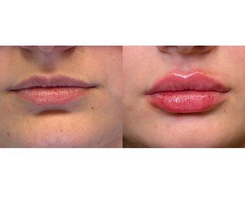 Before and after - Lip filler