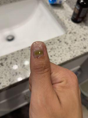 Trying to treat my nail.