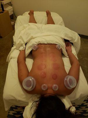 We Offer Cupping Treatments