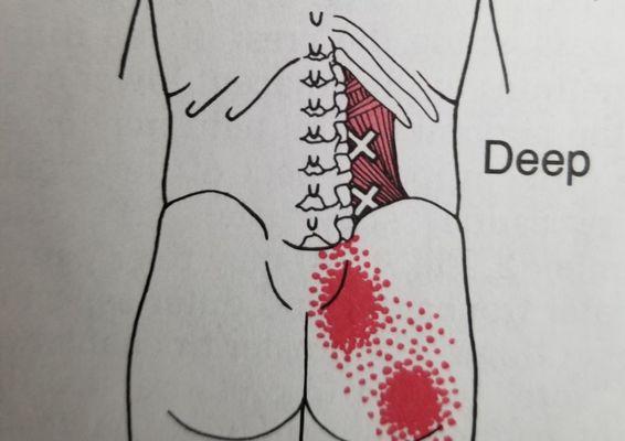 Low back trigger points often mimic sciatic pain. 
Book your appointment online today.