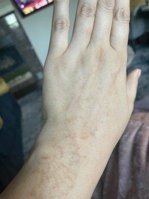 Chemical burn from July 2021 from mehndi application done at Heena Salon for Eid.