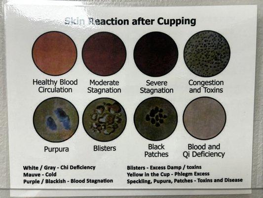 A chart of what the cupping marks mean!