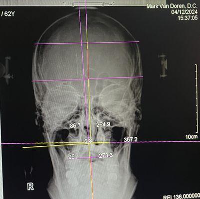 Although my head is straight in one way, the doctor can measure the distance the Atlas disc alignment, is off.