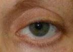 Example of lower eyelid retraction and high crease on same eye.  See how horrible that looks!