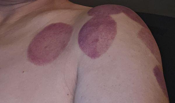 Chinese cupping treatment results