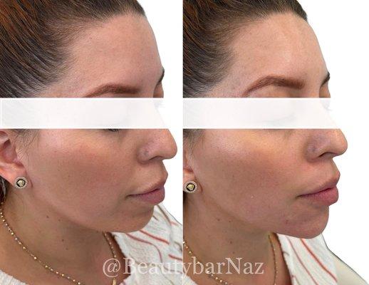 Jawline and Chin Filler done by Naz P.A. 4 syringes were used to achieve this beauty look